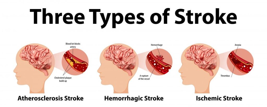 infographic-common-types-stroke