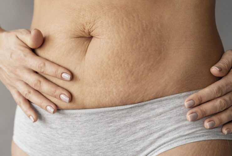 Stretch Marks After Weight Loss