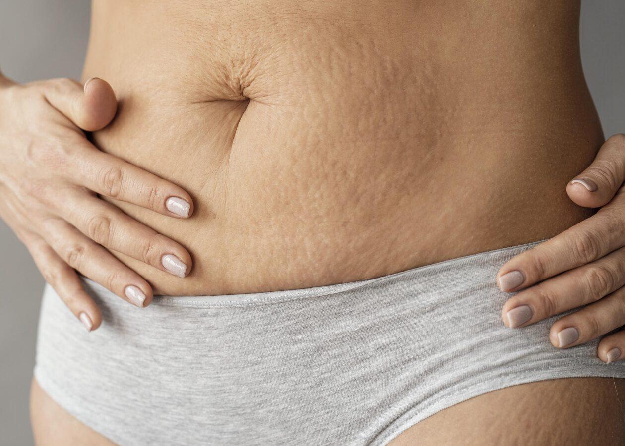 understanding-stretch-marks-after-weight-loss