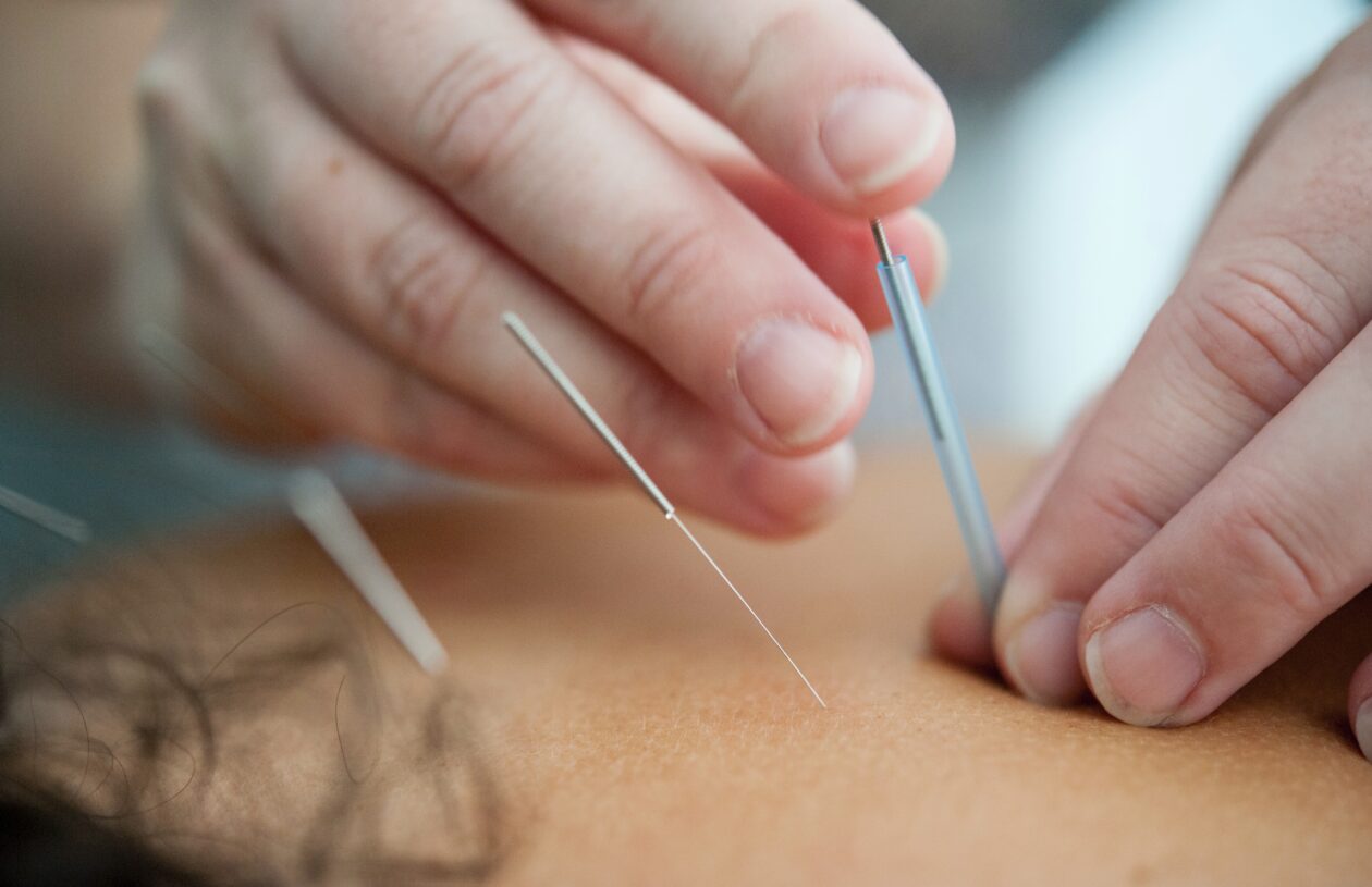 Can you eat before acupuncture?